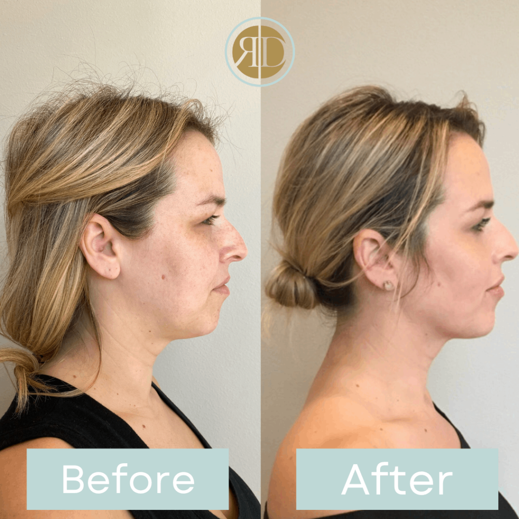 Facial filler & Neurotoxin Before & After Image | Rediscover Aesthetic