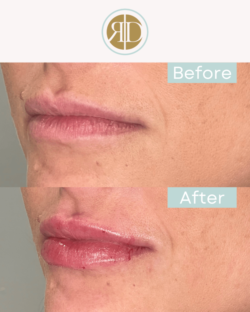 Lip Filler Before & After | Rediscover Aesthetic | LA