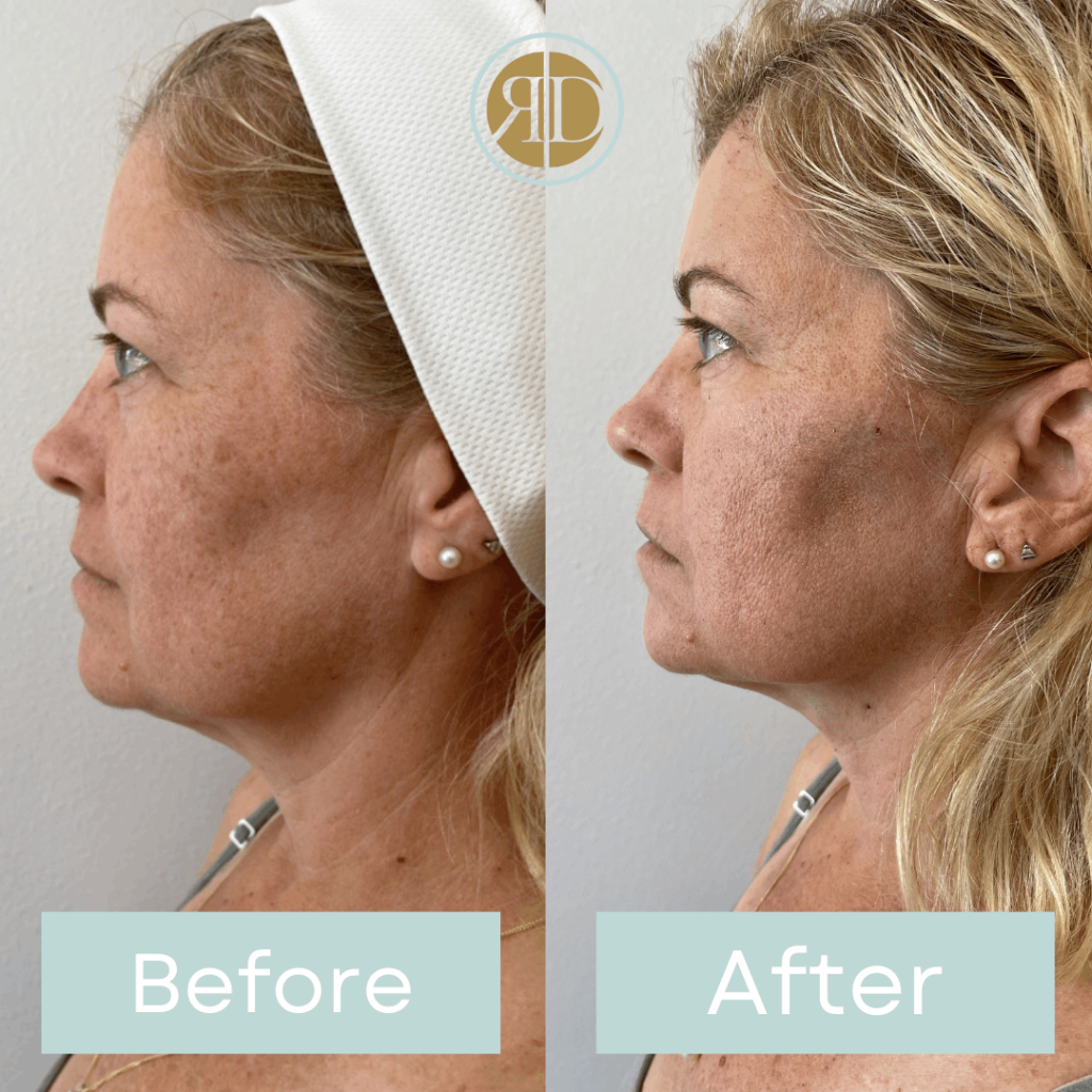 Before After PDO Thread lift | Rediscover Aesthetic