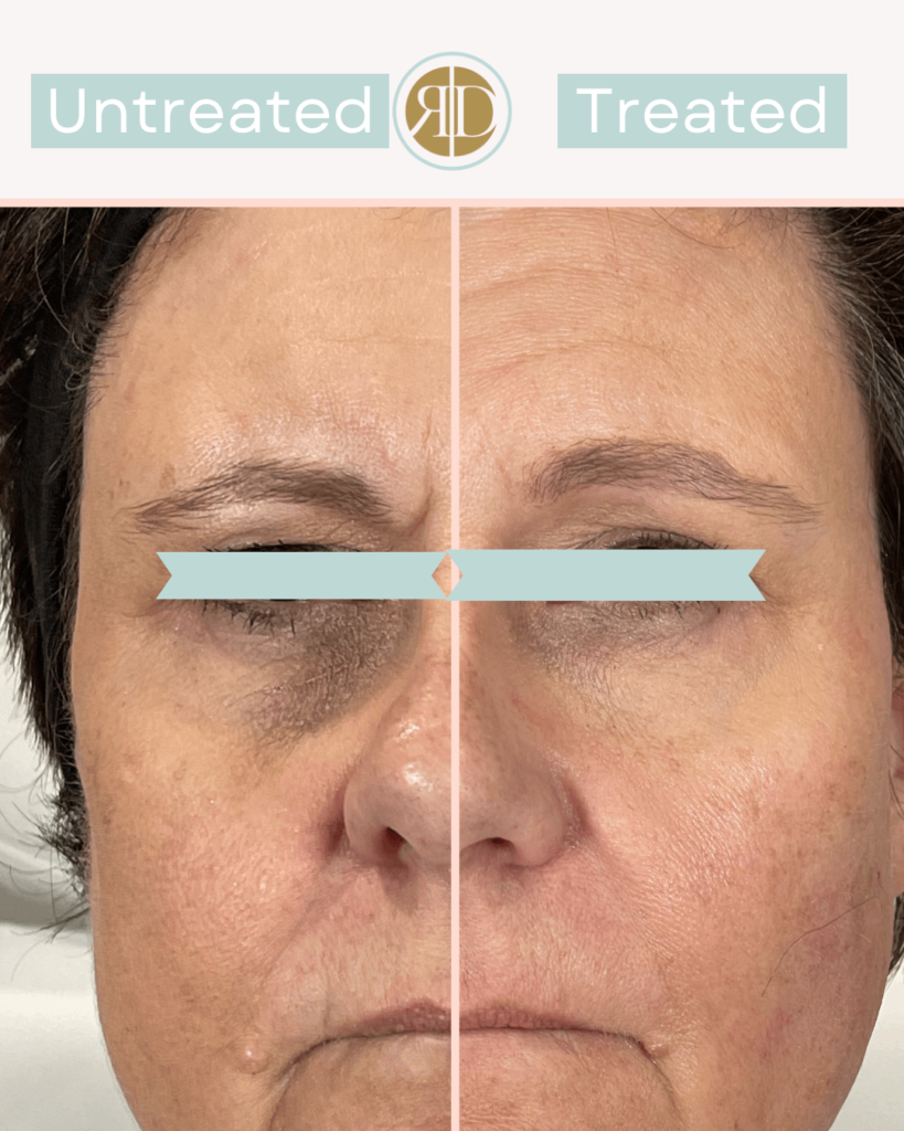 Before After PDO Thread lift | Rediscover Aesthetic