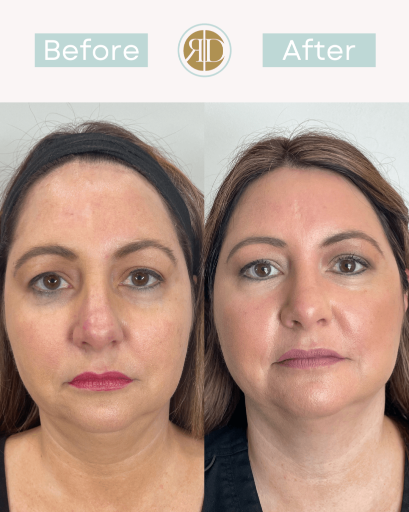 Thread lift Before & After | Rediscover Aesthetics | Mandeville, LA