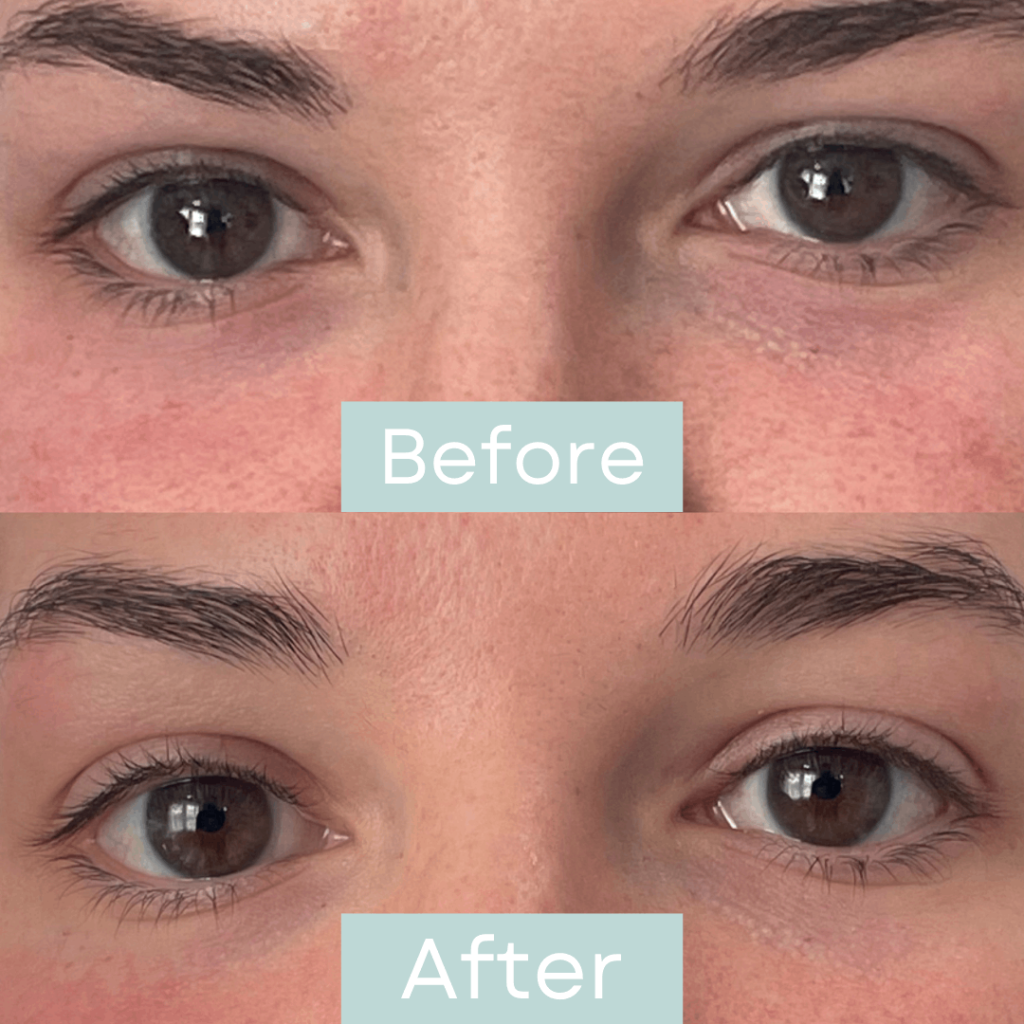 Under eye filler Before & After Image | Rediscover Aesthetic