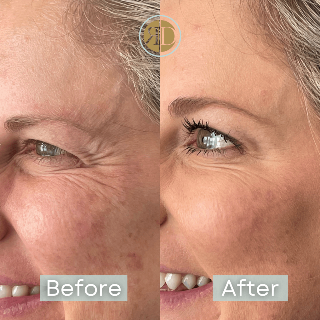Before After Xeomin | Rediscover Aesthetic