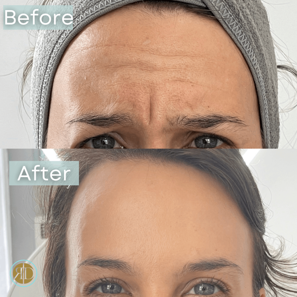 Before After Xeomin | Rediscover Aesthetic