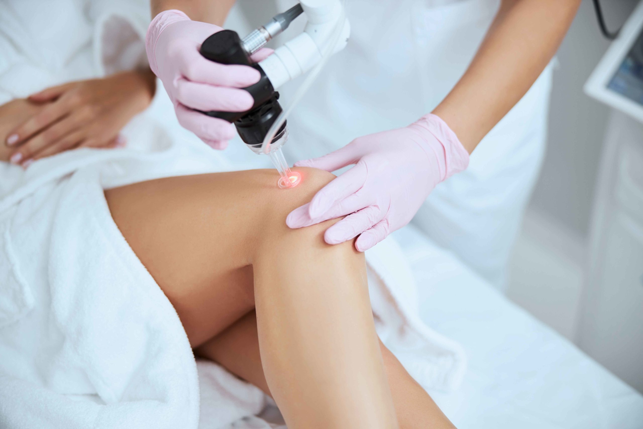 Laser Spider Vein Removal in By Rediscover