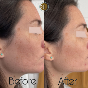 microneedling vs chemical peel before after la rediscover aesthetic