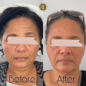 microneedling vs chemical peel before afters la rediscover aesthetic