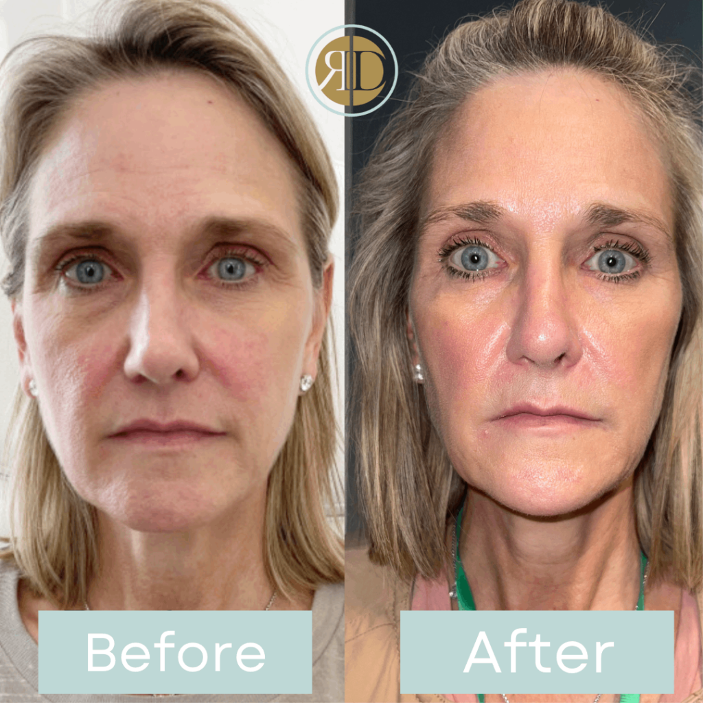 before after facial filler five la rediscover aesthetic