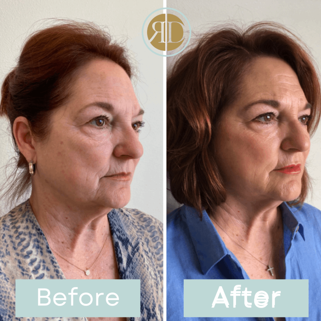 before after facial filler four la rediscover aesthetic