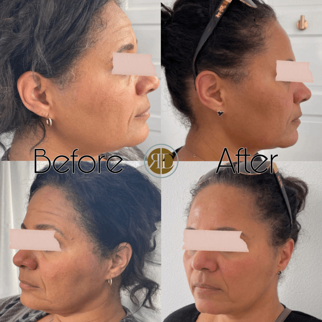 Facial filler & Neurotoxin Before & After Image | Rediscover Aesthetic
