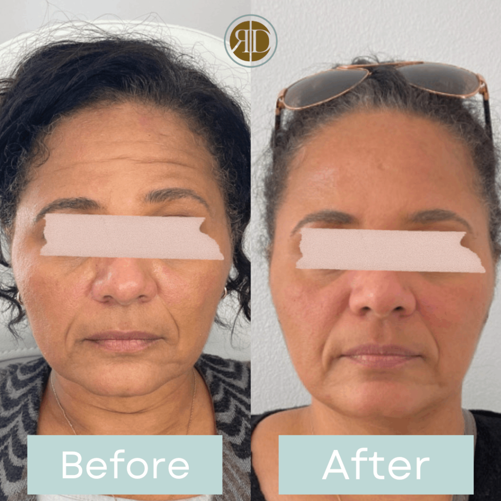 before after facial filler neurotoxin two la rediscover aesthetic