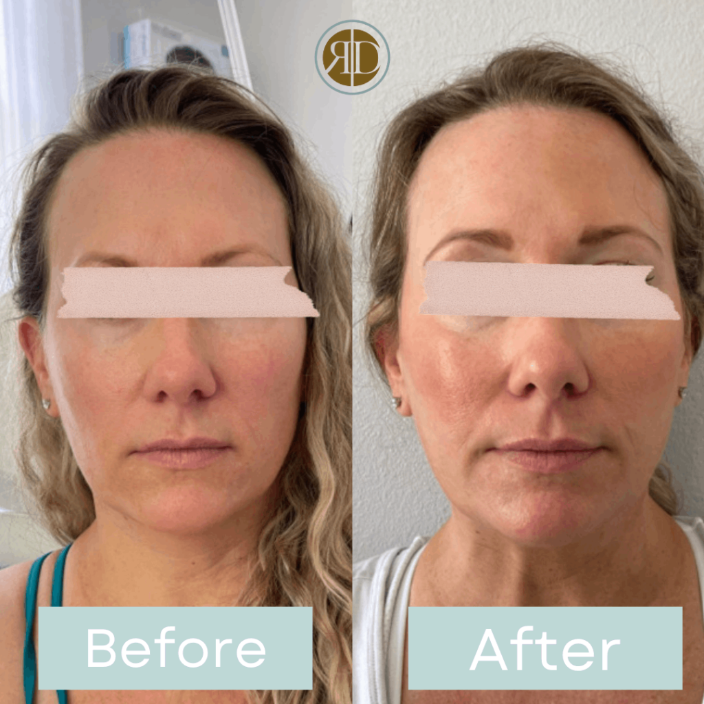 before after facial filler one la rediscover aesthetic