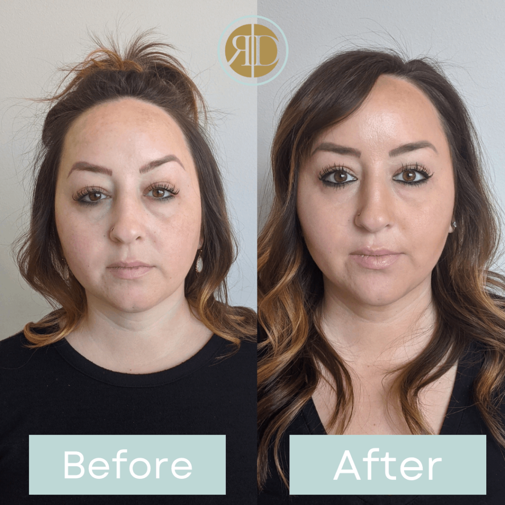 before after facial filler seven la rediscover aesthetic