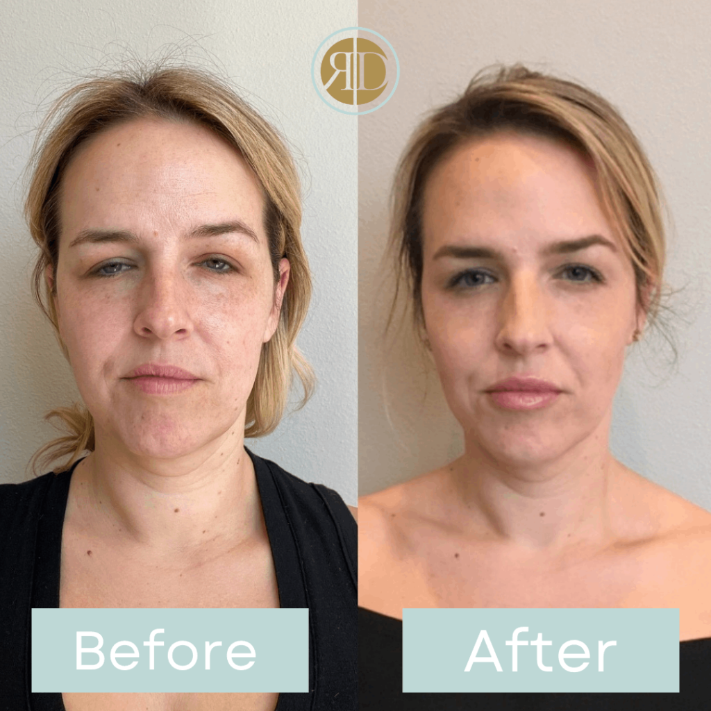 before after facial filler six la rediscover aesthetic