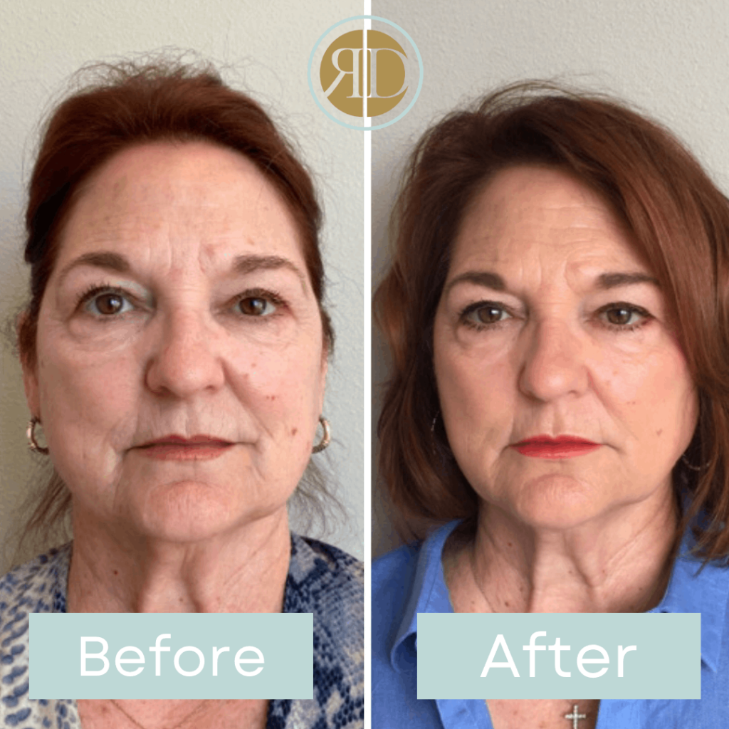 before after facial filler three la rediscover aesthetic