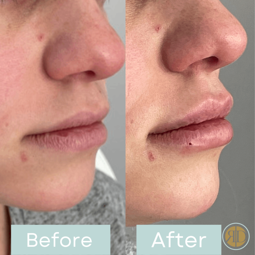 before after lip filler five la rediscover aesthetic