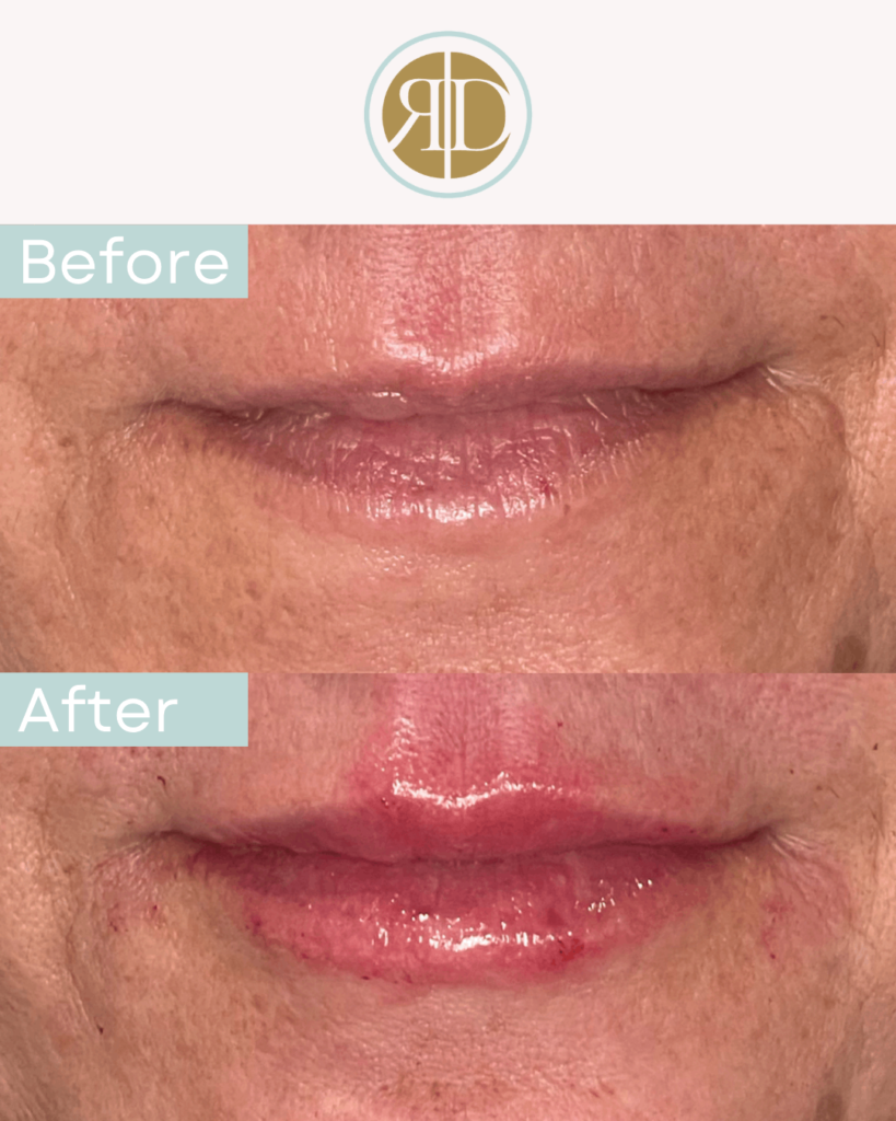 before after lip filler four la rediscover aesthetic