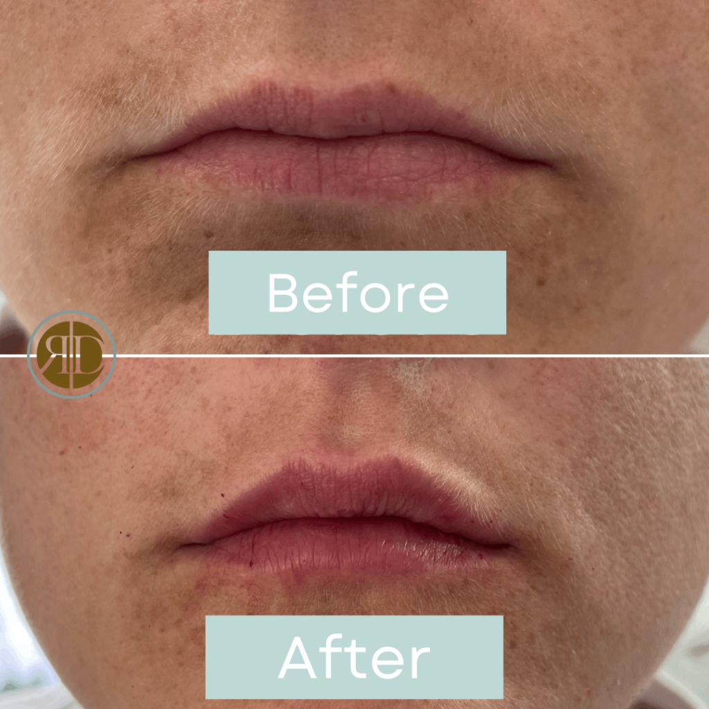 before after lip filler one la rediscover aesthetic