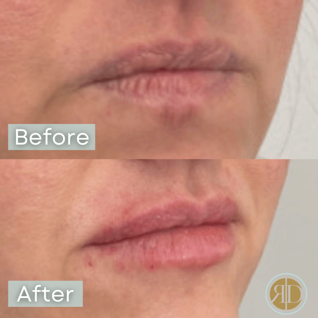 Lip Filler Before & After | Rediscover Aesthetic | LA