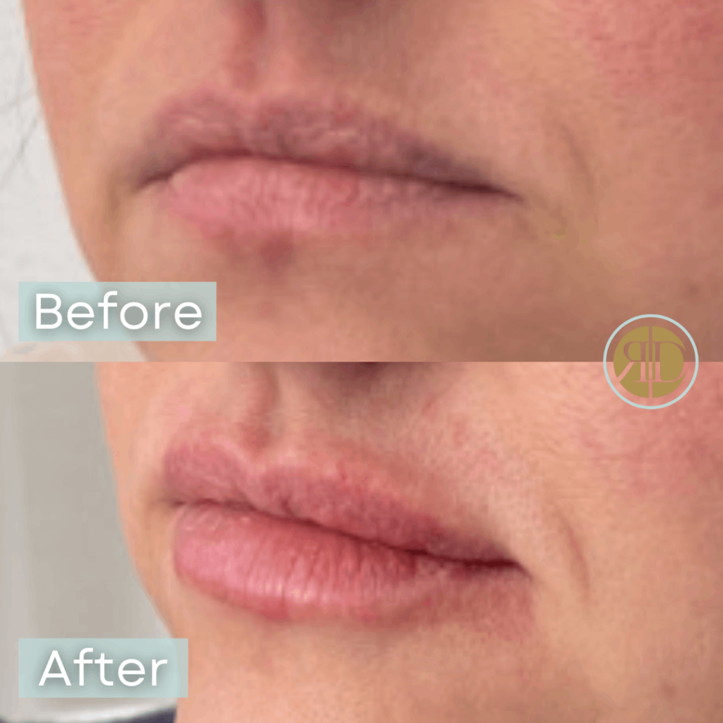 before after lip filler six la rediscover aesthetic