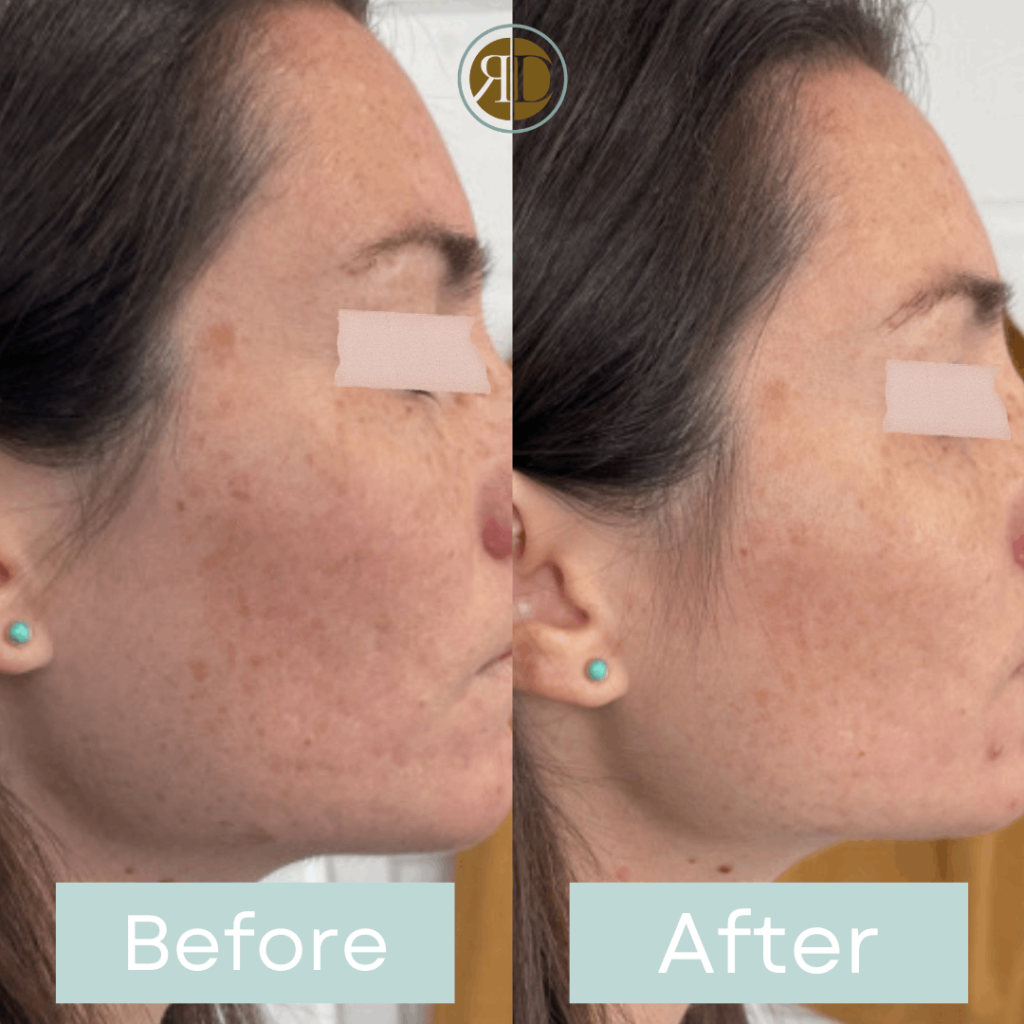 before after microneedling four la rediscover aesthetic