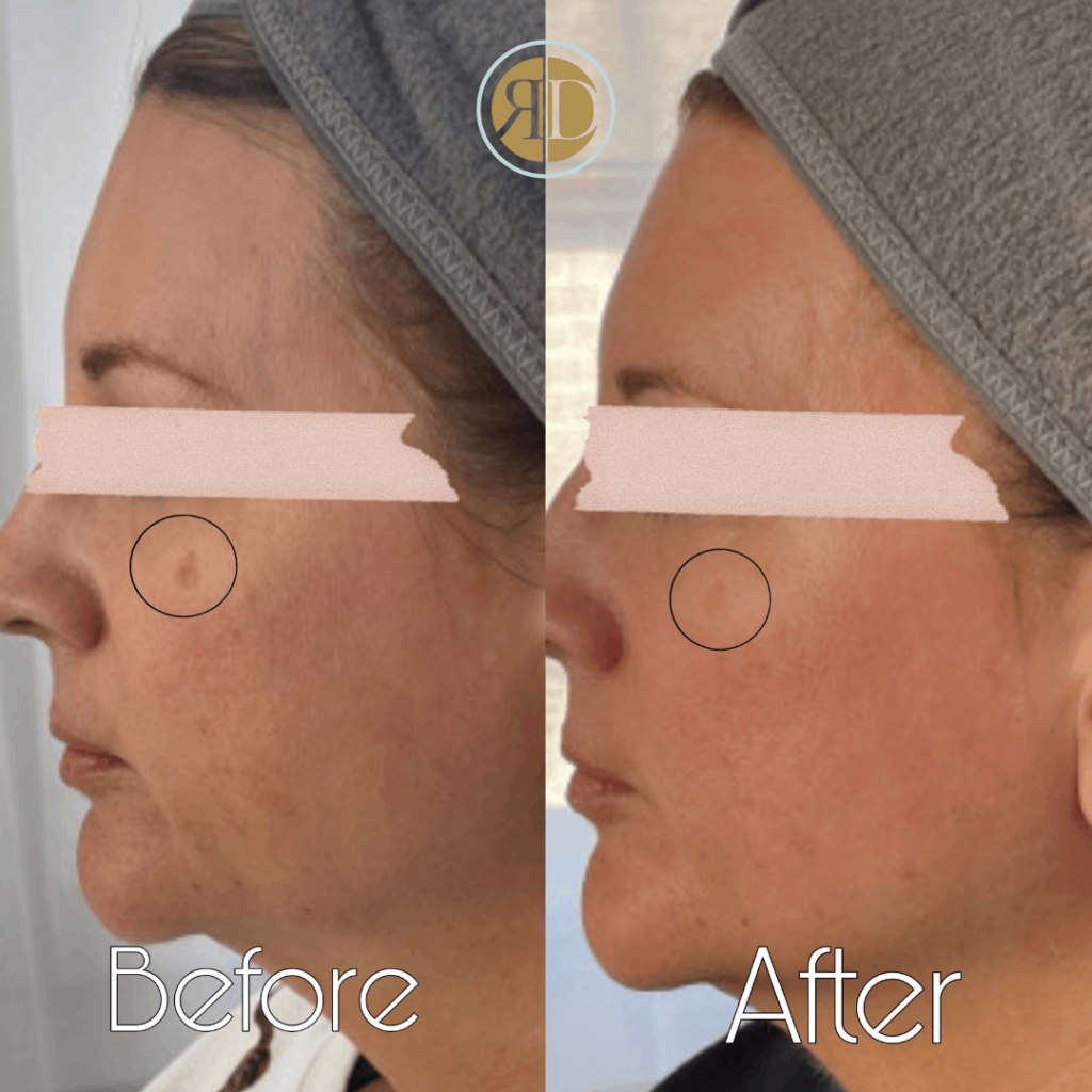before after microneedling one la rediscover aesthetic