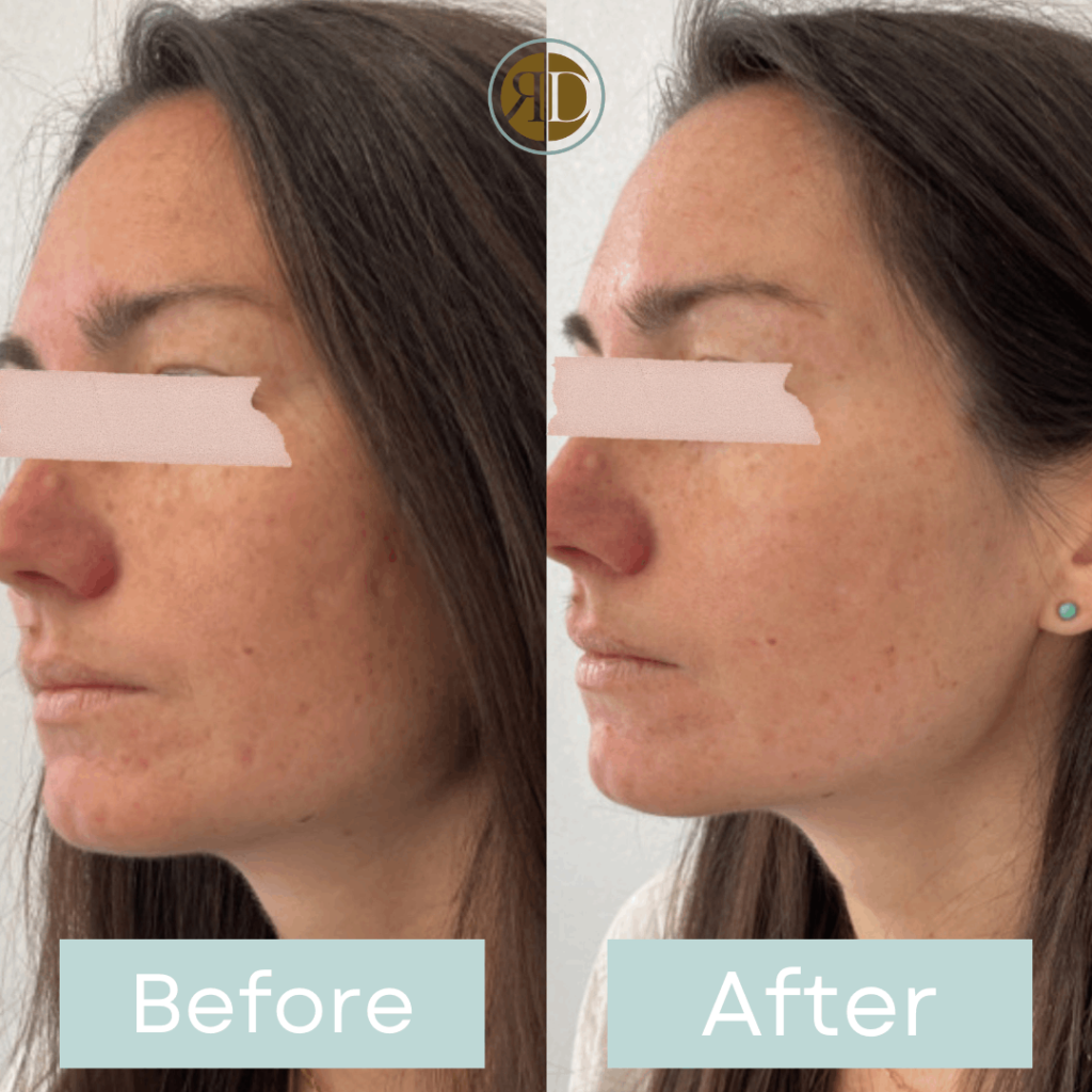 Microneedling Before & After Image | Rediscover Aesthetic | LA