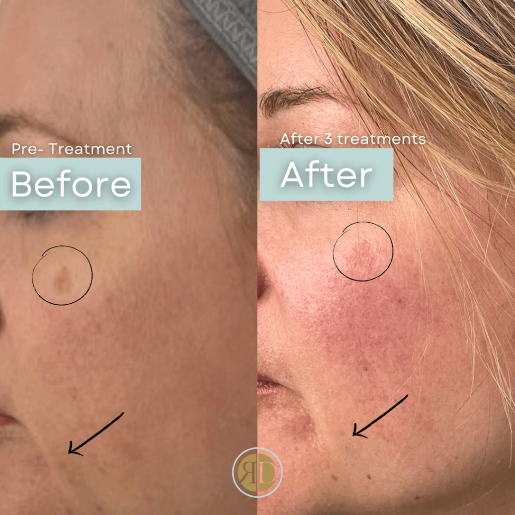 before after microneedling two la rediscover aesthetic