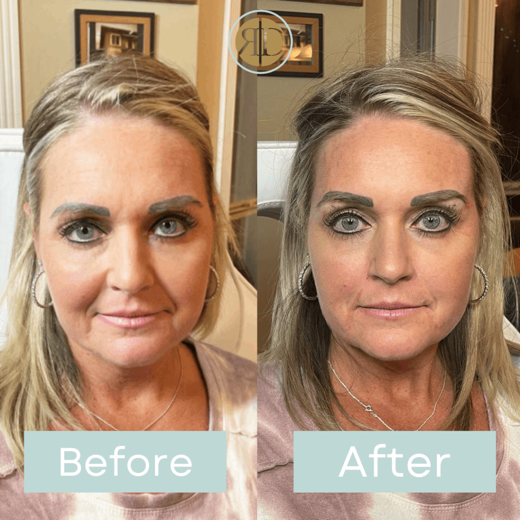Before After PDO Brow Lift & Facial filler | Rediscover Aesthetic
