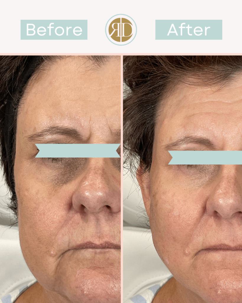 before after pdo thread lift two la rediscover aesthetic