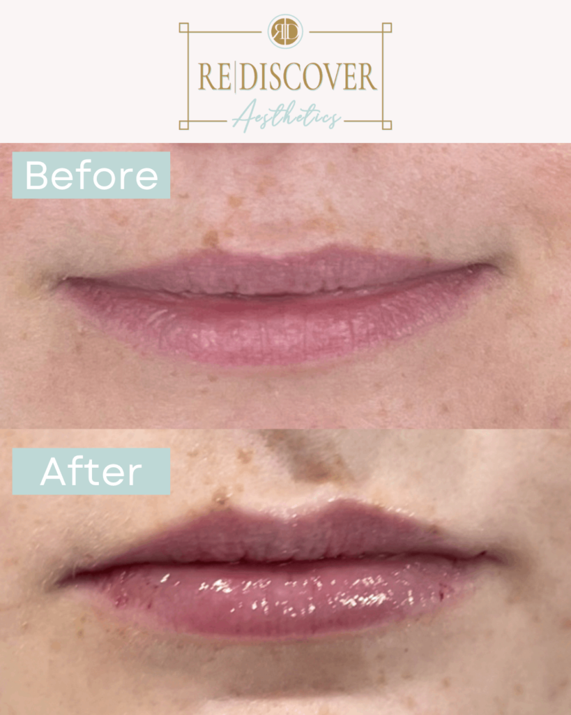 Smooth threads lips Before & After Image | Rediscover Aesthetic
