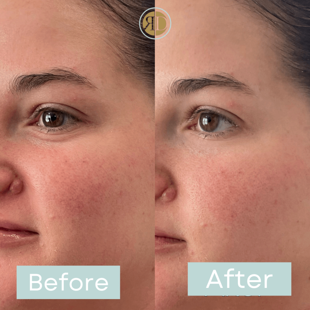 before after under eye filler one la rediscover aesthetic