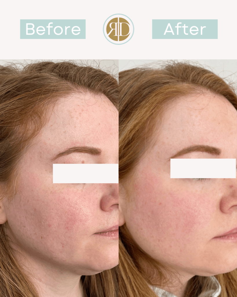before after vi peel la rediscover aesthetic