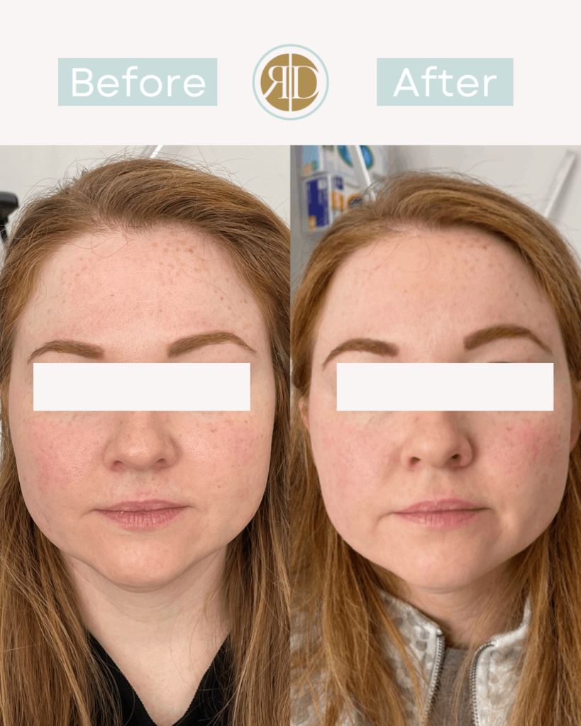 before after vi peel two la rediscover aesthetic