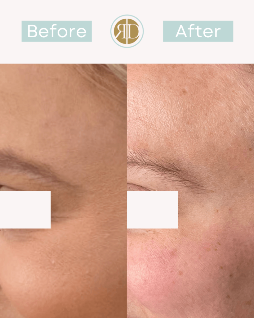 before after xeomin a peterson crows feet la rediscover aesthetic