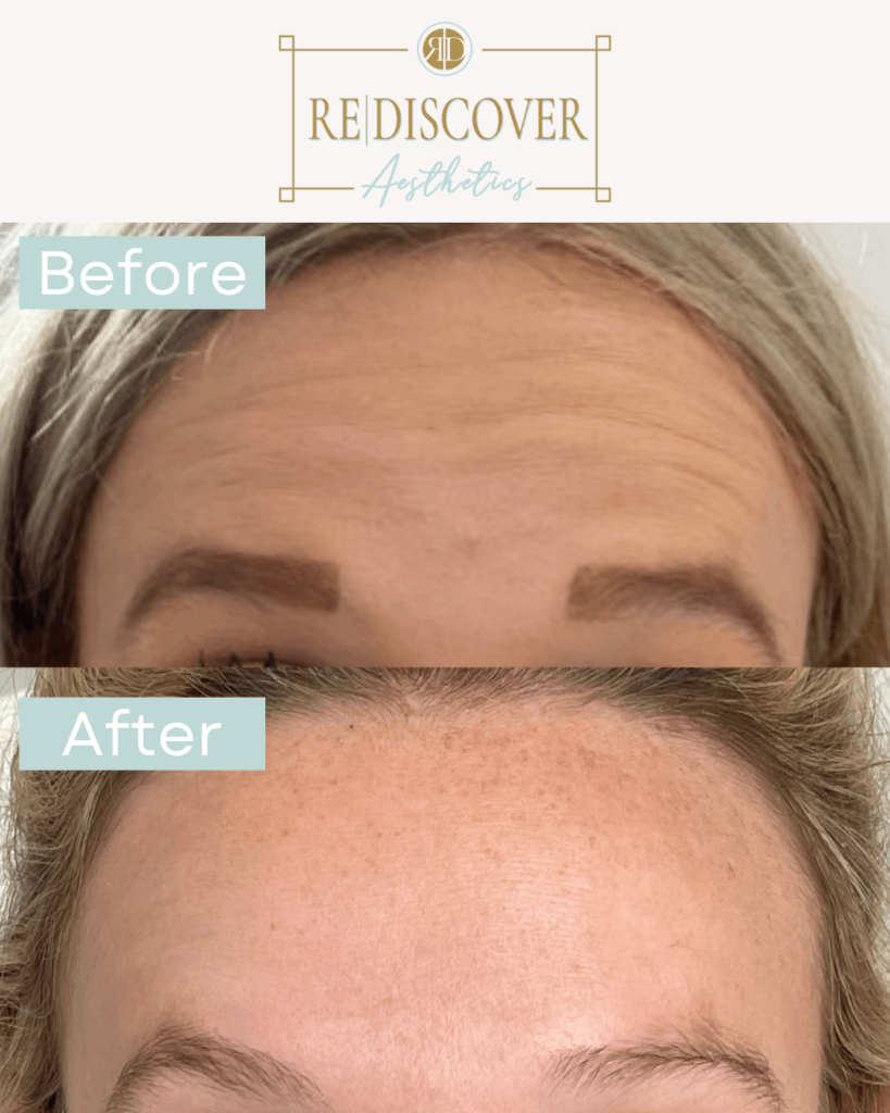 before after xeomin a peterson forehead four la rediscover aesthetic
