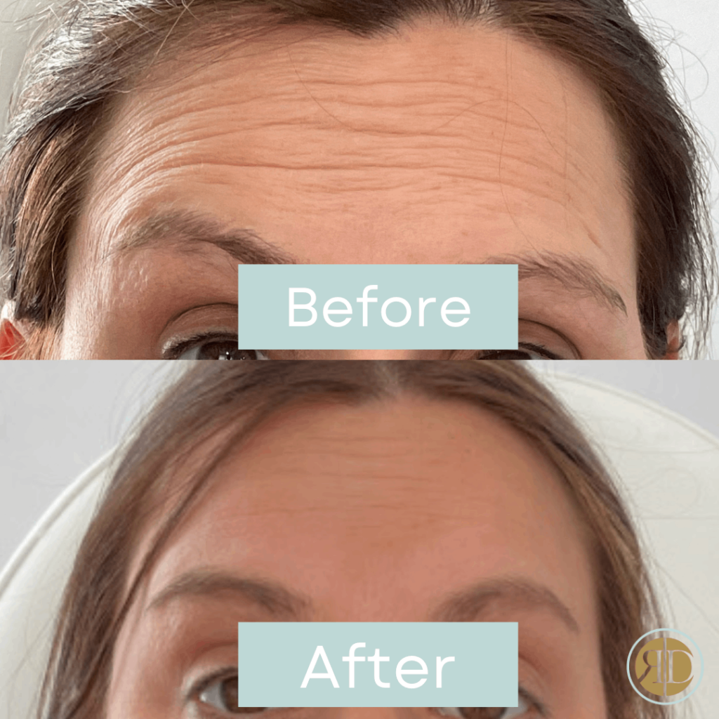 before after xeomin b landry forehead la rediscover aesthetic