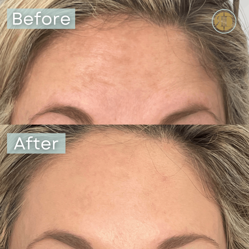 before after xeomin forehead a la rediscover aesthetic