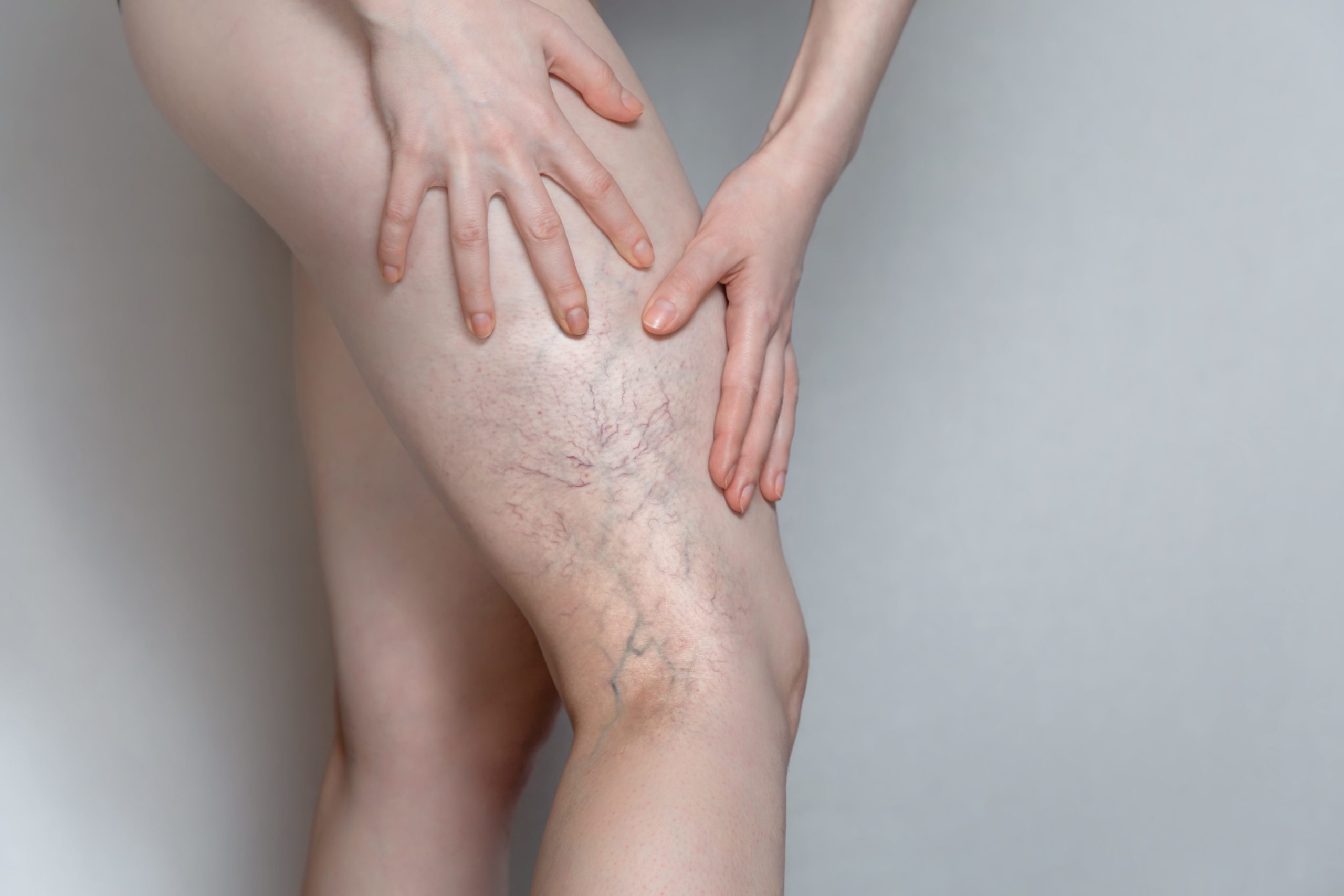 What Is Better For Spider Veins, Laser Or Injections
