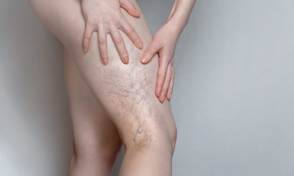 What Is Better For Spider Veins, Laser Or Injections